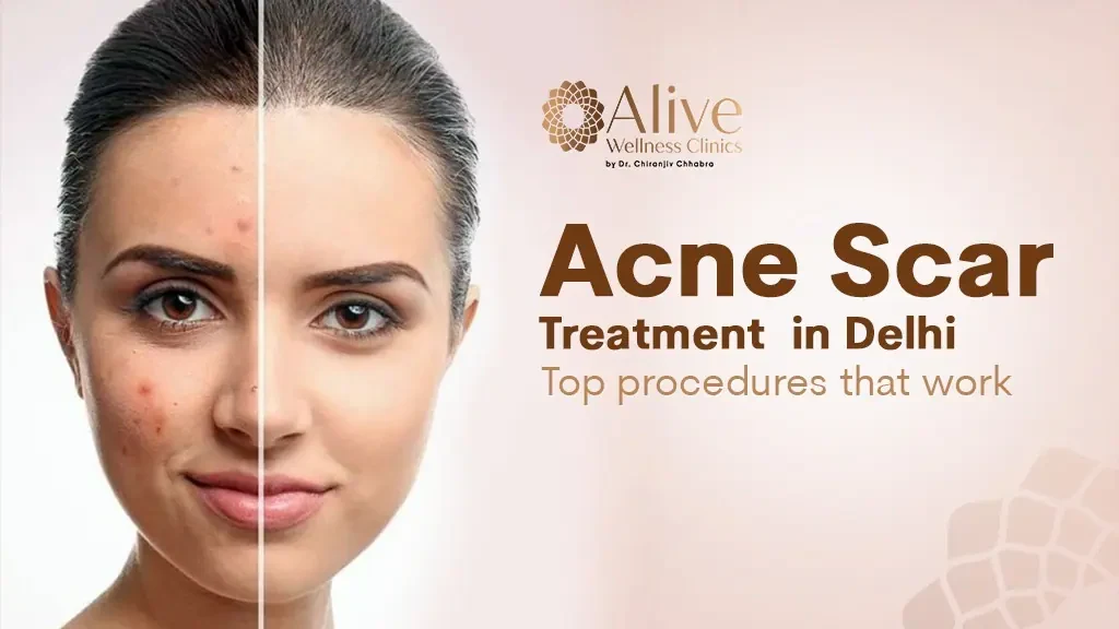 Acne Scar Treatment in Delhi: Top Procedures That Work