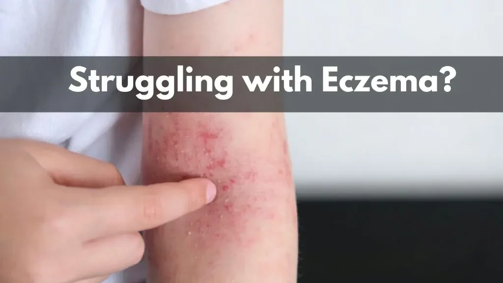 Best Eczema Treatment in Delhi