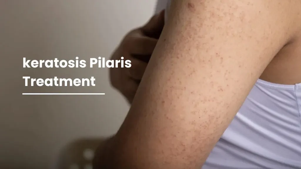 Keratosis Pilaris Treatment