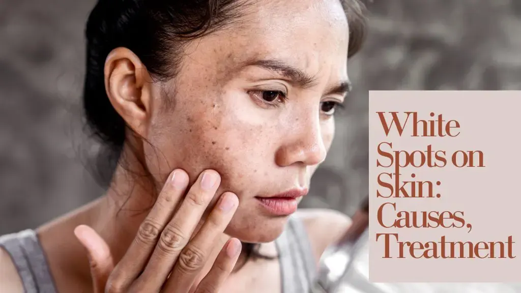 White Spots on Skin: Causes And Treatment