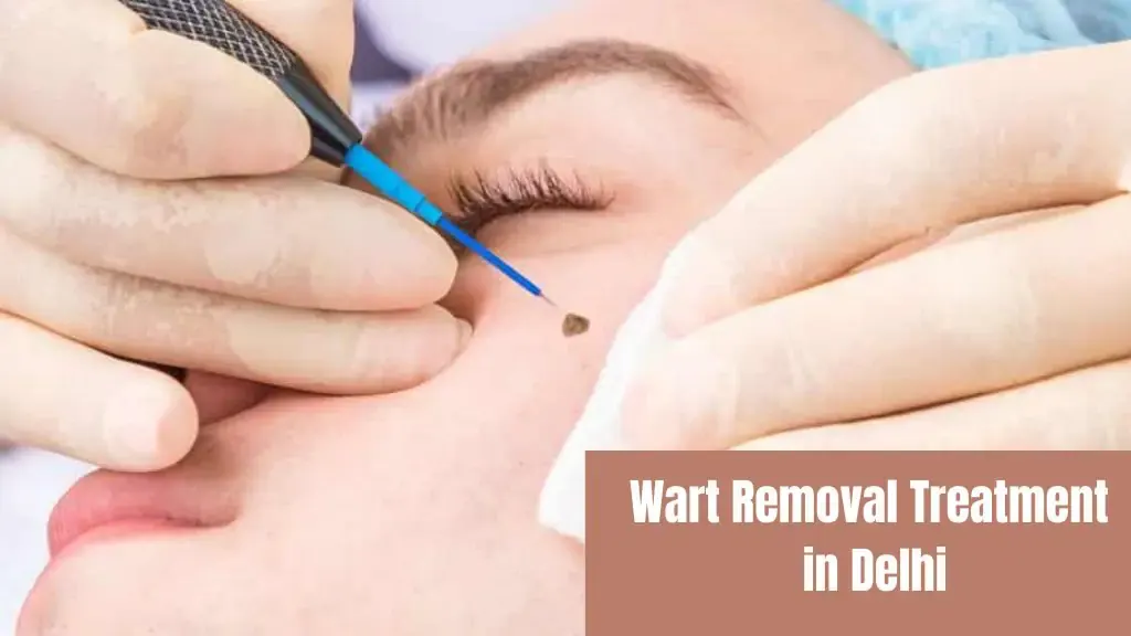Wart Removal Treatment in Delhi