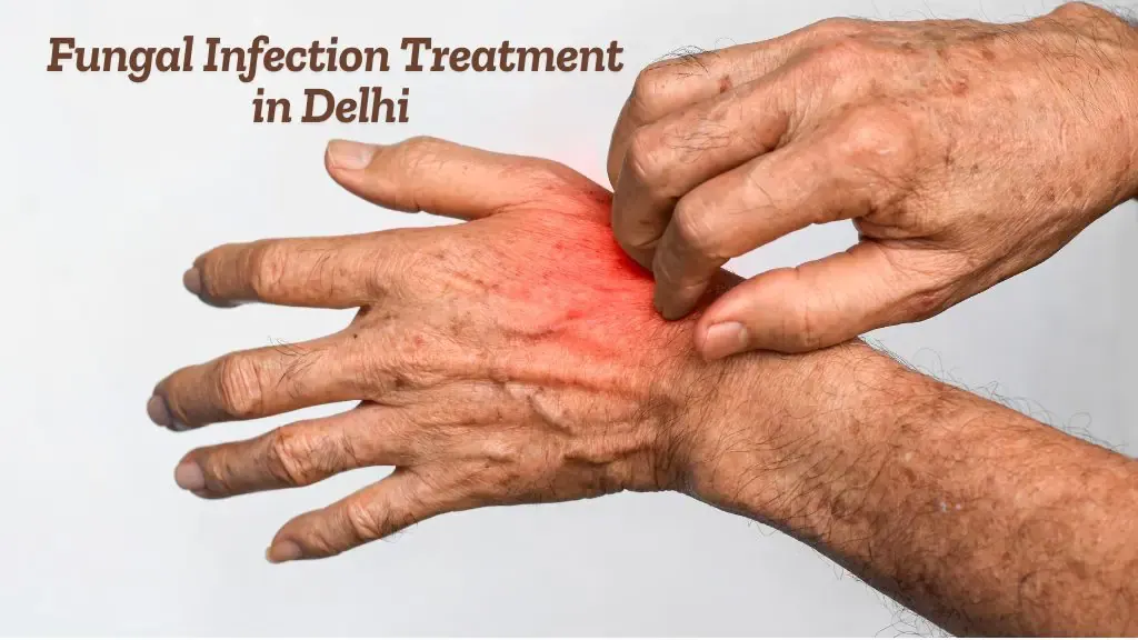 Fungal Infection Treatment in Delhi