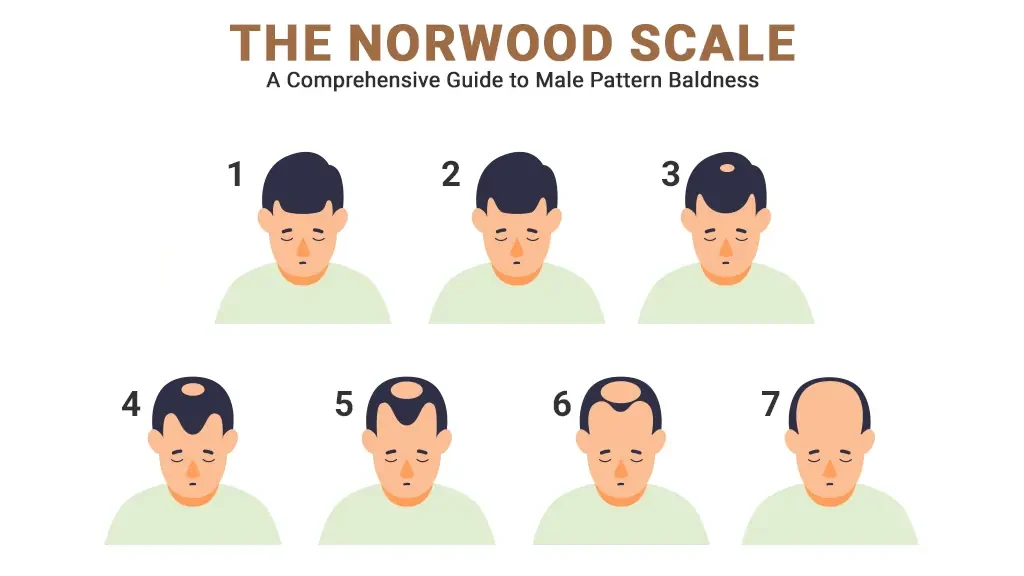 7 Stages of the Norwood Scale
