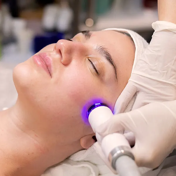 Acne healing laser