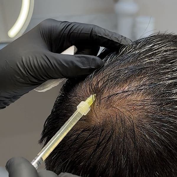 Platelet-Rich Plasma treatment (PRP)