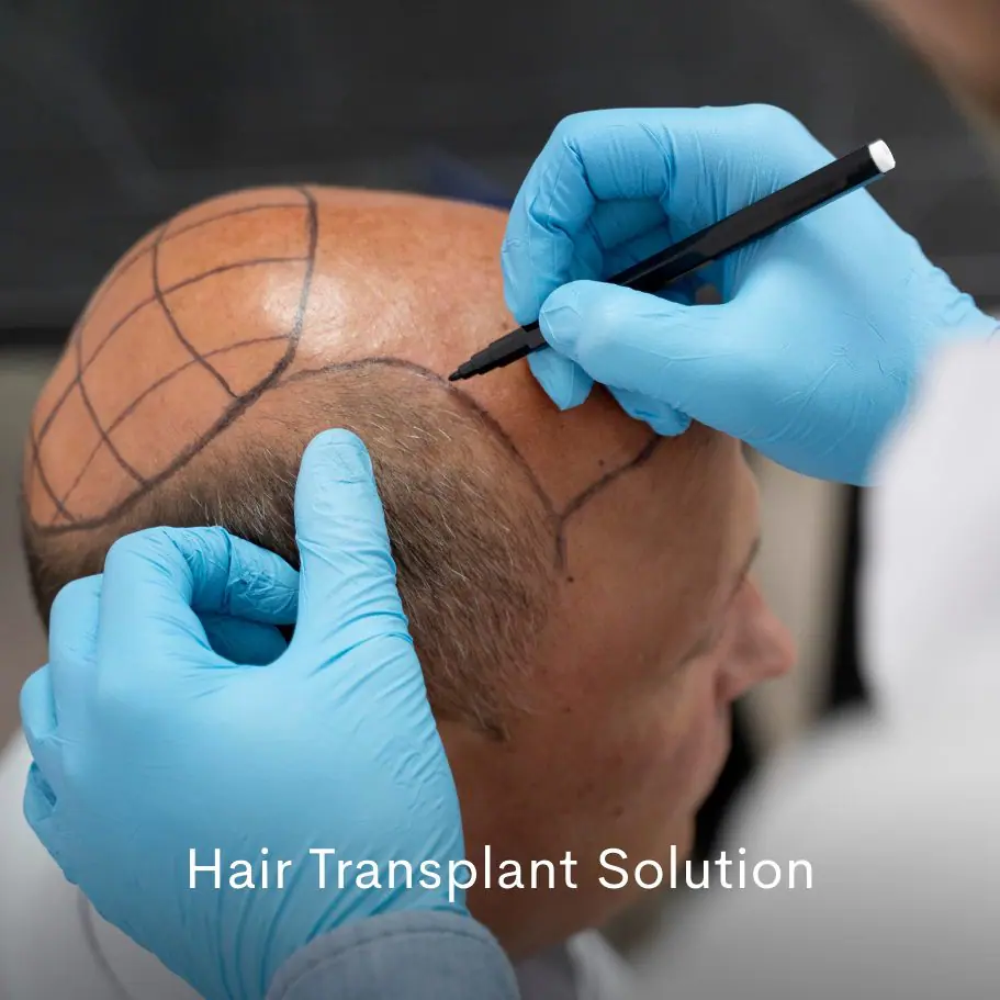 Hair Transplant