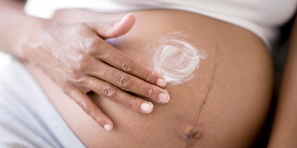 Read more about the article 5 Ways To Minimize The Appearance Of Stretch Marks After Pregnancy