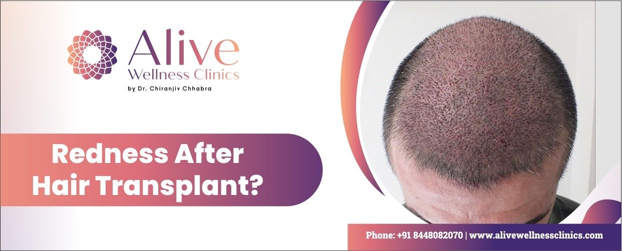 Read more about the article Redness After Hair Transplant