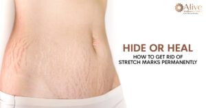 Read more about the article Hide or Heal: How to Get Rid of Stretch Marks Permanently