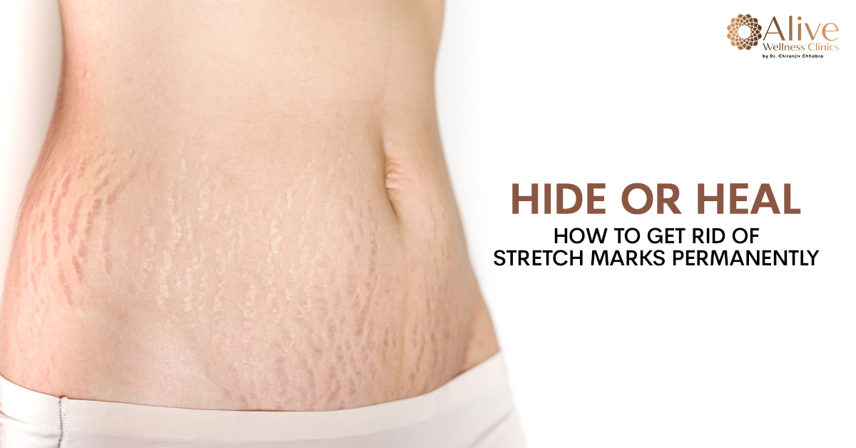 You are currently viewing Hide or Heal: How to Get Rid of Stretch Marks Permanently