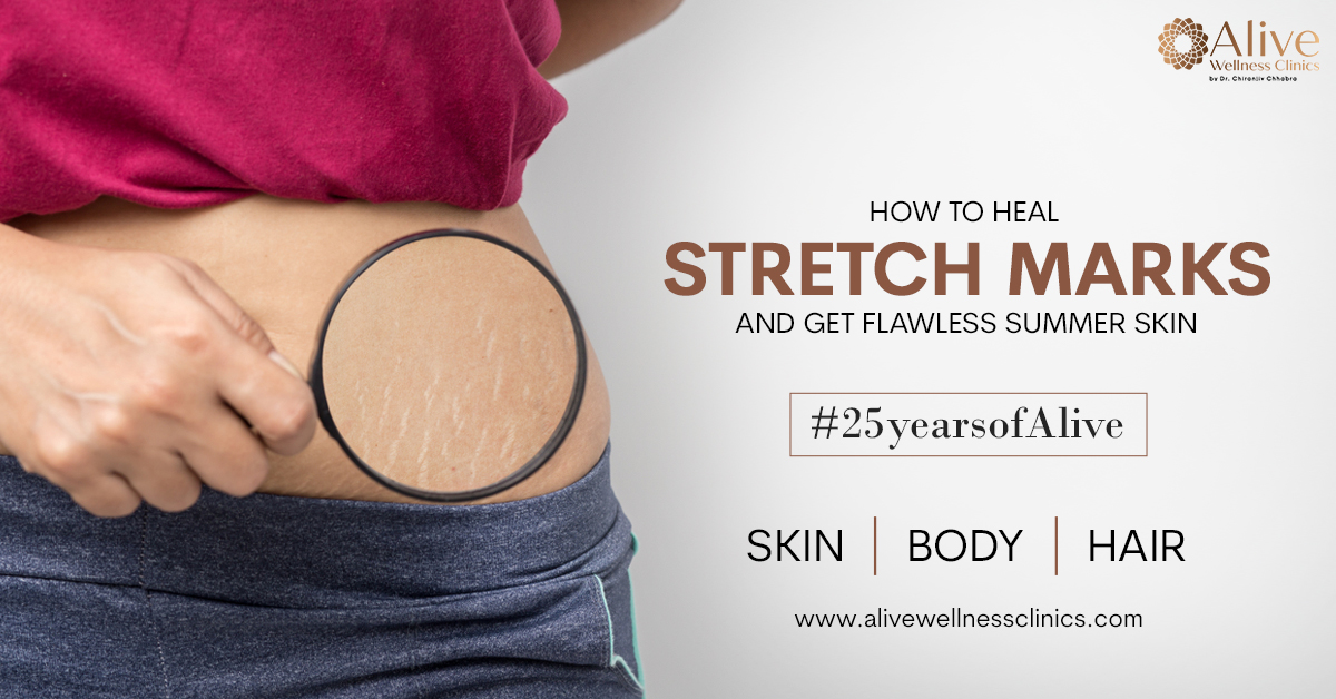 Read more about the article How to Heal Stretch Marks and Get Flawless Summer Skin