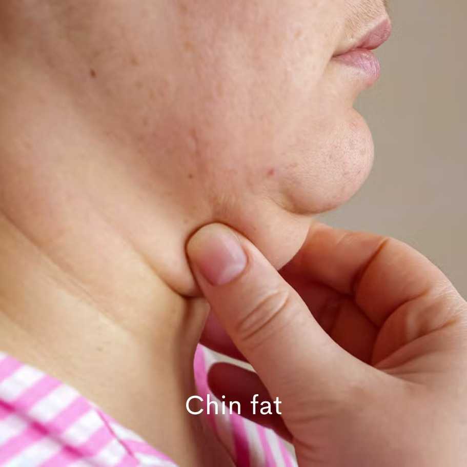 Double Chin
