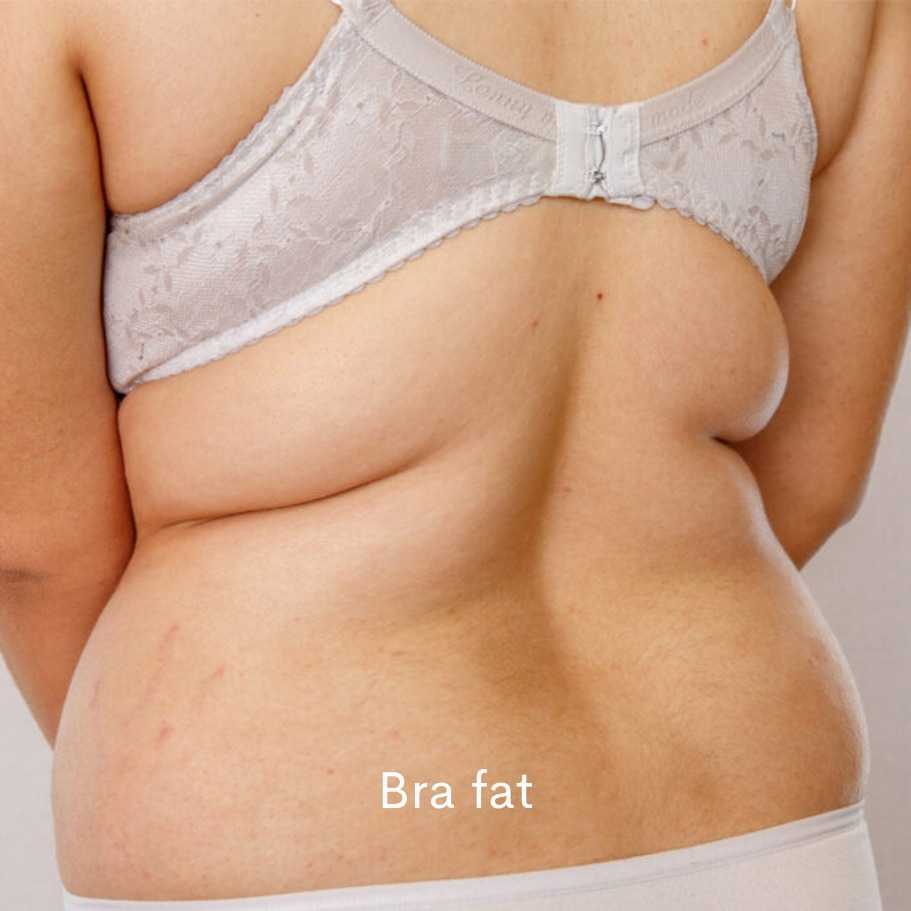 Bra Bulge