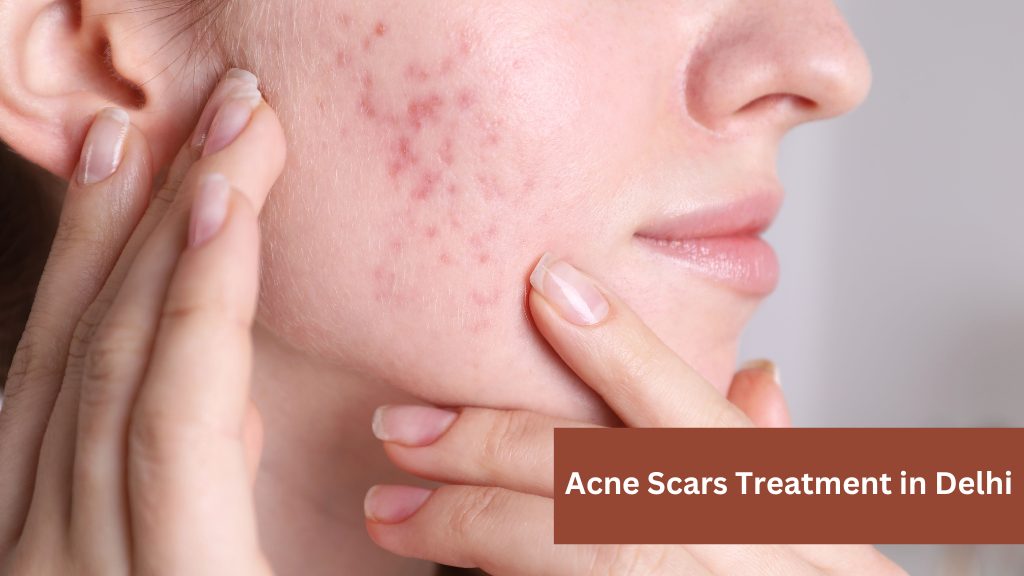 Acne Scars Treatment in Delhi