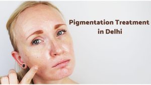 Pigmentation Treatment in Delhi