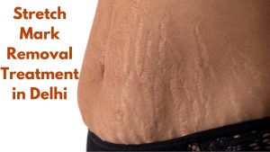 Stretch Mark Removal Treatment in Delhi