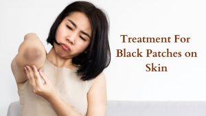 Treatment For Black Patches on Skin