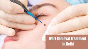 Wart Removal Treatment in Delhi