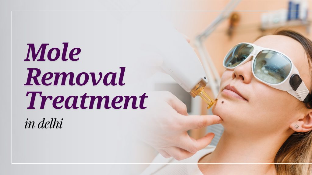 mole removal treatment in Delhi