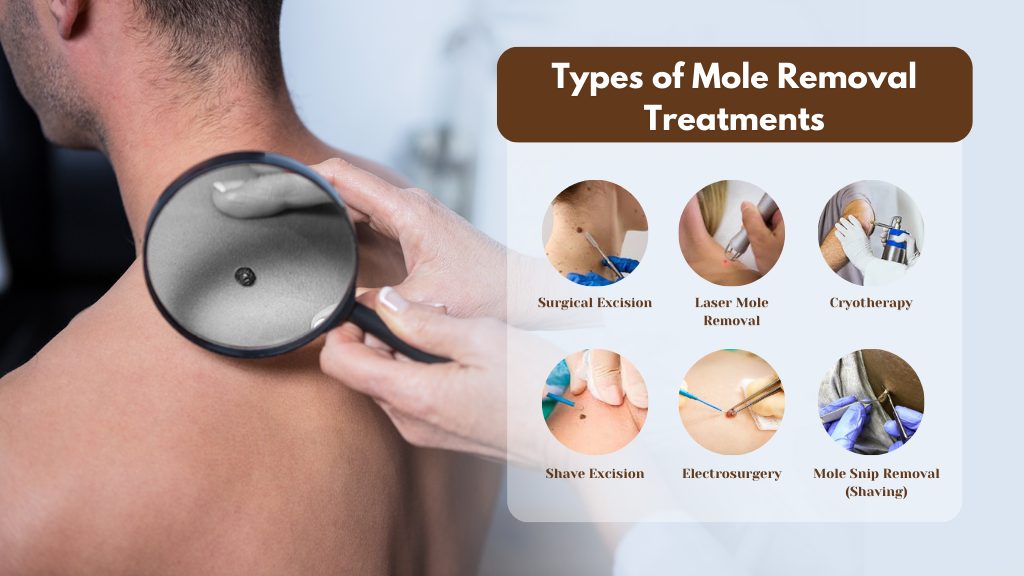 types of mole removal treatments