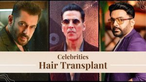 Celebrities Hair Transplants