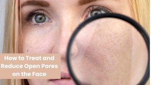 Open Pores on the Face