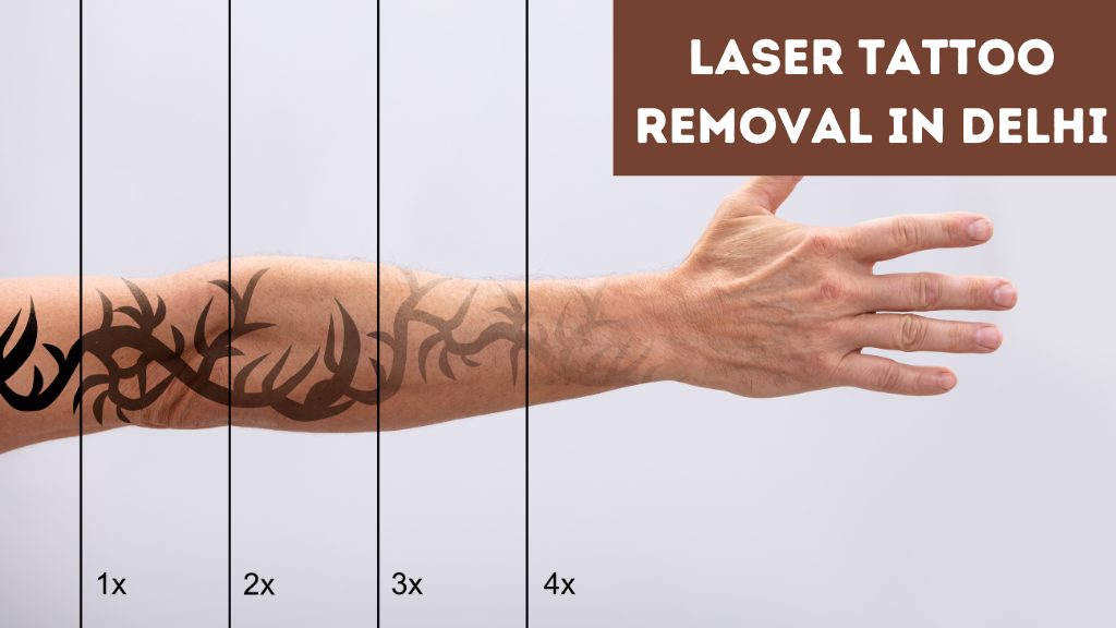 Laser Tattoo Removal in Delhi