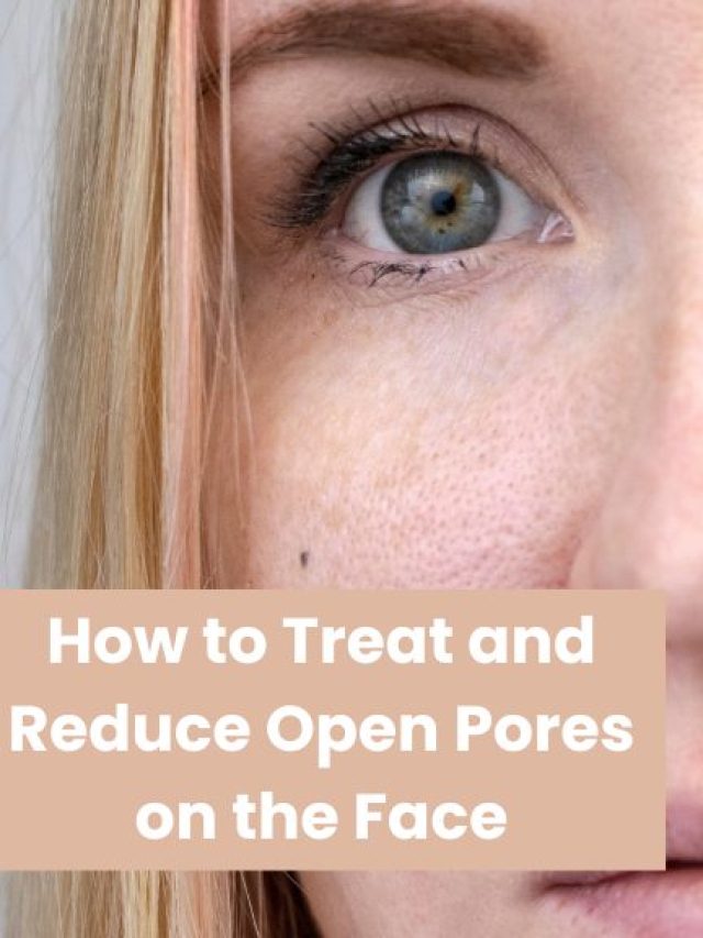 Best treatment for open pores in Delhi | Reduce Open Pores