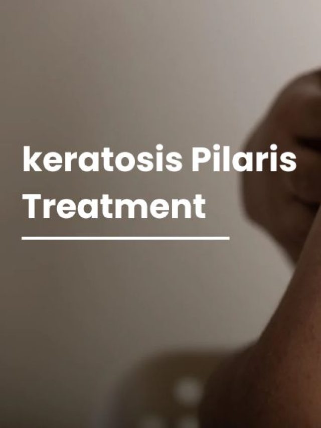 Keratosis Pilaris Treatment