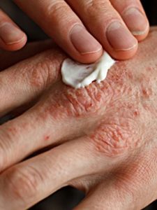 eczema treatment